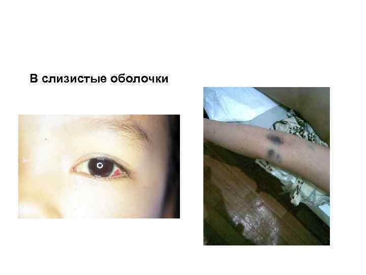 В слизистые оболочки 