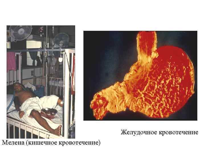 Желудочное кровотечение Мелена (кишечное кровотечение) 