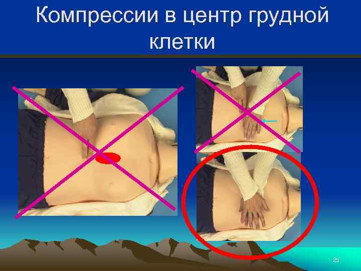 Компрессии в центр грудной клетки 25 