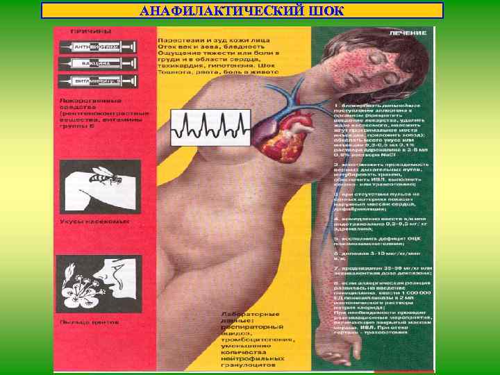АНАФИЛАКТИЧЕСКИЙ ШОК 