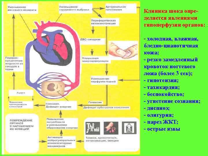 Клиника шока опре деляется явлениями гипоперфузии органов: холодная, влажная, бледно цианотичная кожа; резко замедленный
