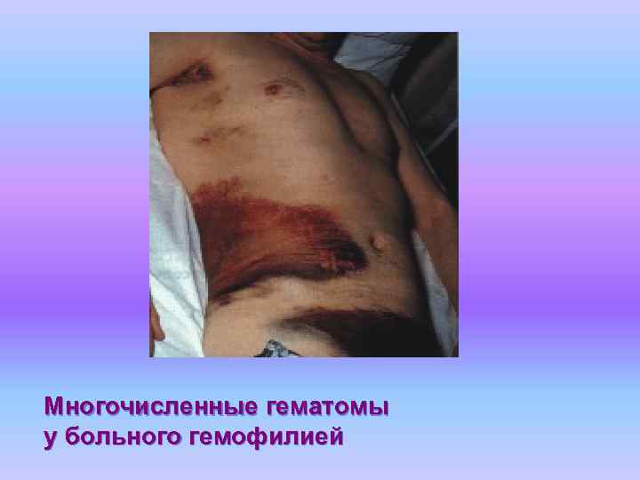 Многочисленные гематомы у больного гемофилией 