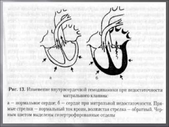 Схема гемодинамики при пороках сердца - 94 фото