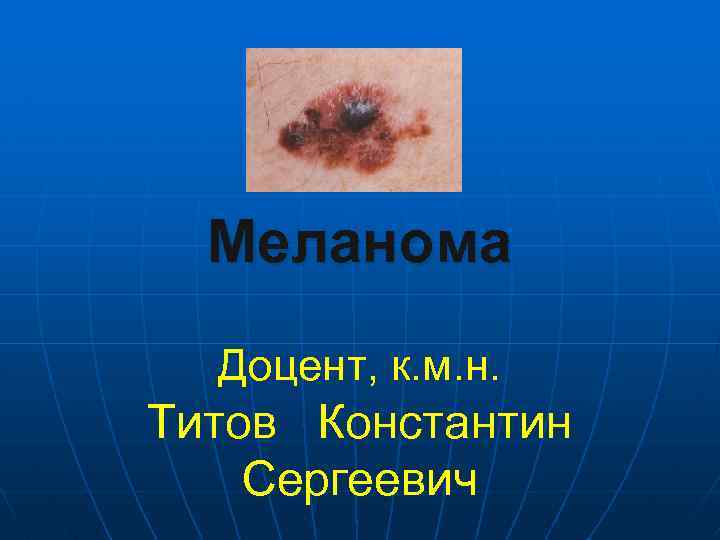 Меланома Доцент, к. м. н. Титов Константин Сергеевич 
