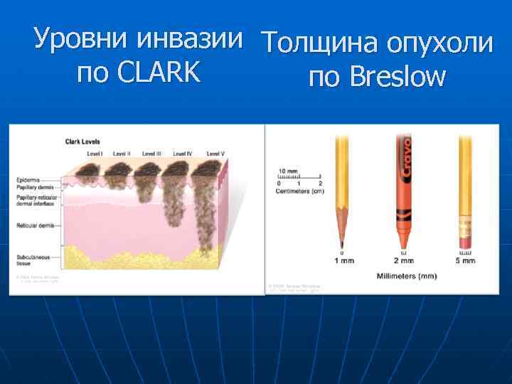 Уровни инвазии меланомы