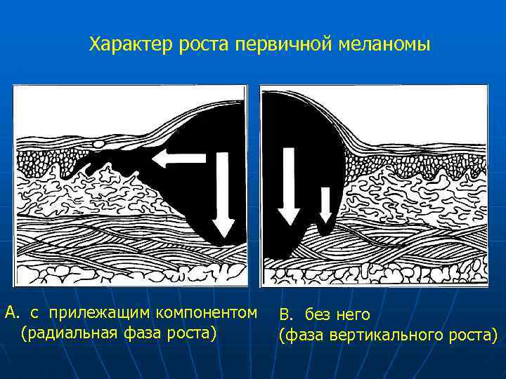 Уровни инвазии меланомы. Меланома фаза радиального роста. Вертикальная фаза роста меланомы. Фаза горизонтального роста меланомы.