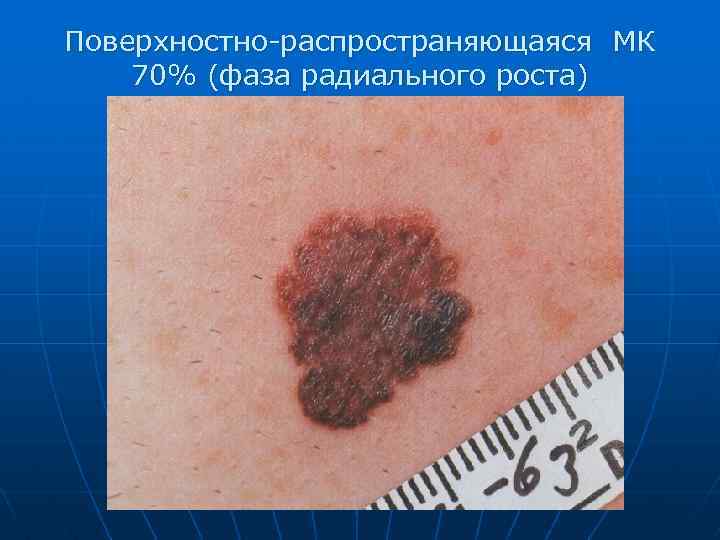 Поверхностно-распространяющаяся МК 70% (фаза радиального роста) 