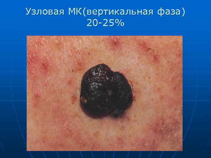 Узловая МК(вертикальная фаза) 20 -25% 