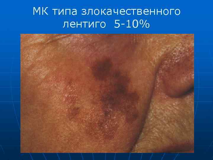 МК типa злокачественного лентиго 5 -10% 