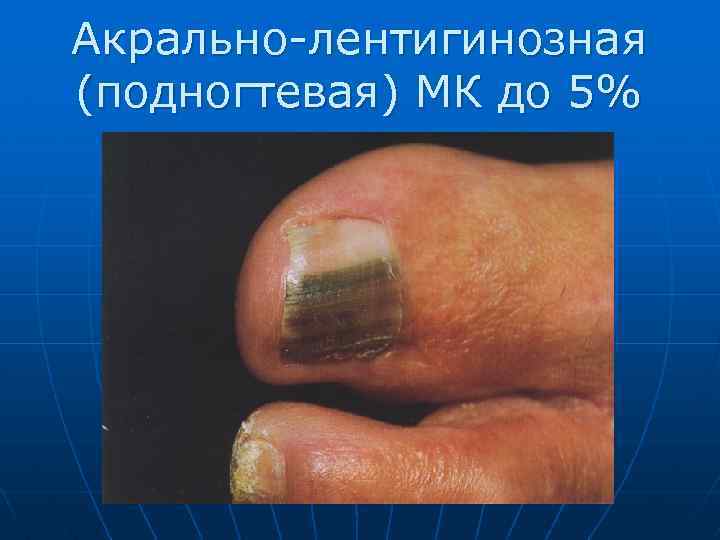 Акрально-лентигинозная (подногтевая) МК до 5% 