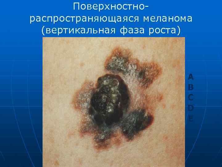 Поверхностнораспространяющаяся меланома (вертикальная фаза роста) A B C D E 