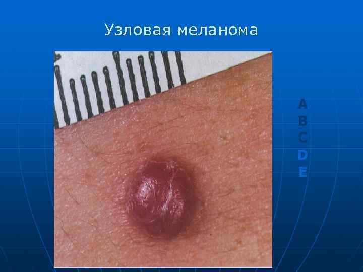 Узловая меланома A B C D E 