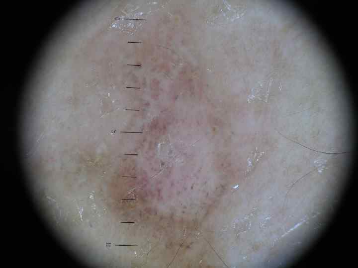 Полная регрессия меланомы кожи 