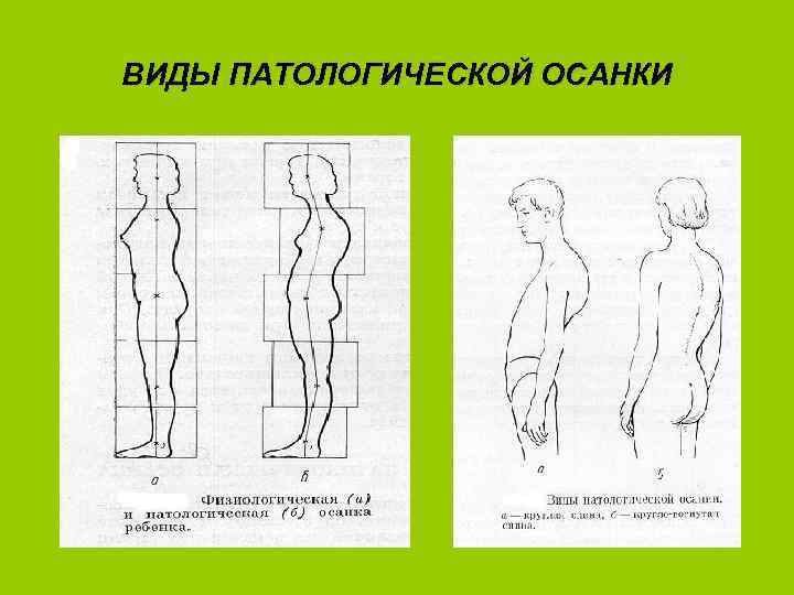 ВИДЫ ПАТОЛОГИЧЕСКОЙ ОСАНКИ 