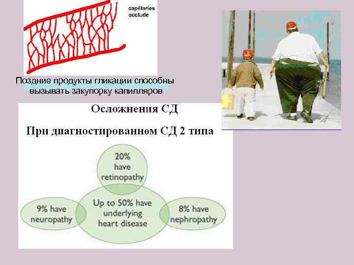 Поздние продукты гликации способны вызывать закупорку капилляров 