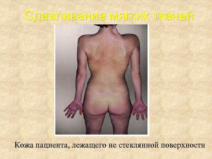 Сдавливание мягких тканей Кожа пациента, лежащего не стеклянной поверхности 