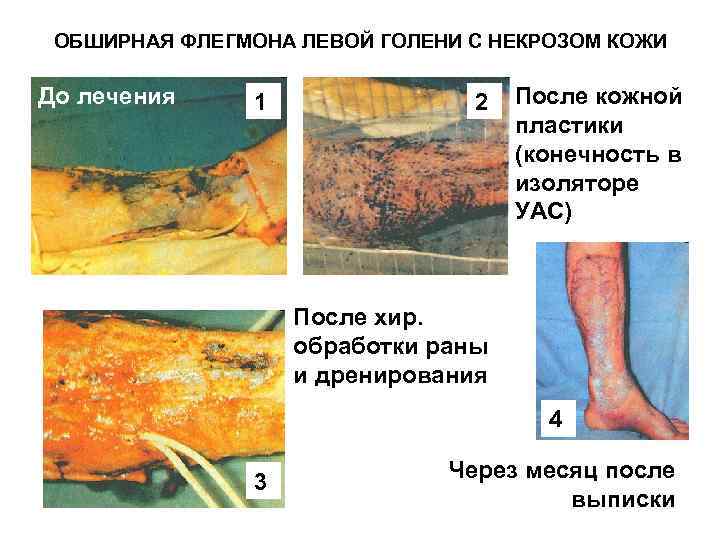 ОБШИРНАЯ ФЛЕГМОНА ЛЕВОЙ ГОЛЕНИ С НЕКРОЗОМ КОЖИ До лечения 1 2 После кожной пластики