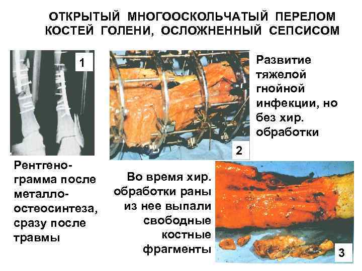 ОТКРЫТЫЙ МНОГООСКОЛЬЧАТЫЙ ПЕРЕЛОМ КОСТЕЙ ГОЛЕНИ, ОСЛОЖНЕННЫЙ СЕПСИСОМ Развитие тяжелой гнойной инфекции, но без хир.