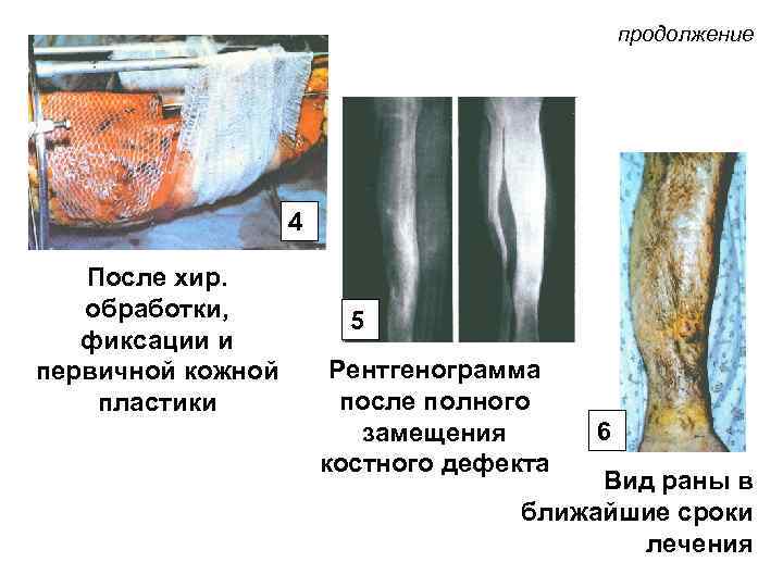 продолжение 4 После хир. обработки, фиксации и первичной кожной пластики 5 Рентгенограмма после полного