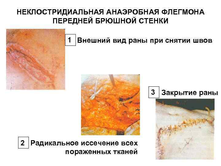 НЕКЛОСТРИДИАЛЬНАЯ АНАЭРОБНАЯ ФЛЕГМОНА ПЕРЕДНЕЙ БРЮШНОЙ СТЕНКИ 1 Внешний вид раны при снятии швов 3