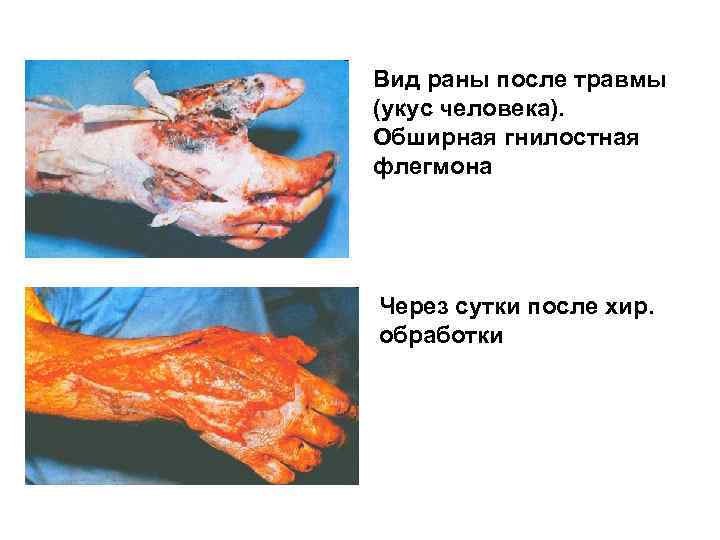 Вид раны после травмы (укус человека). Обширная гнилостная флегмона Через сутки после хир. обработки