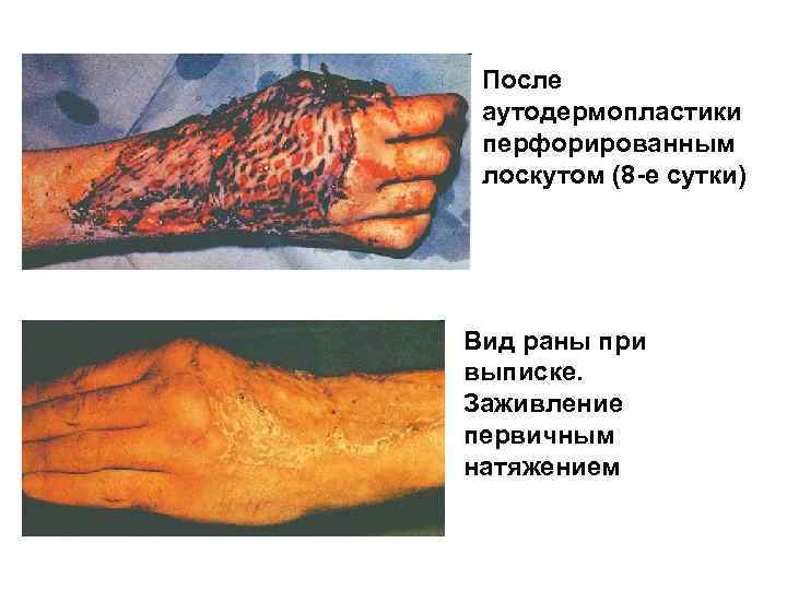 После аутодермопластики перфорированным лоскутом (8 -е сутки) Вид раны при выписке. Заживление первичным натяжением