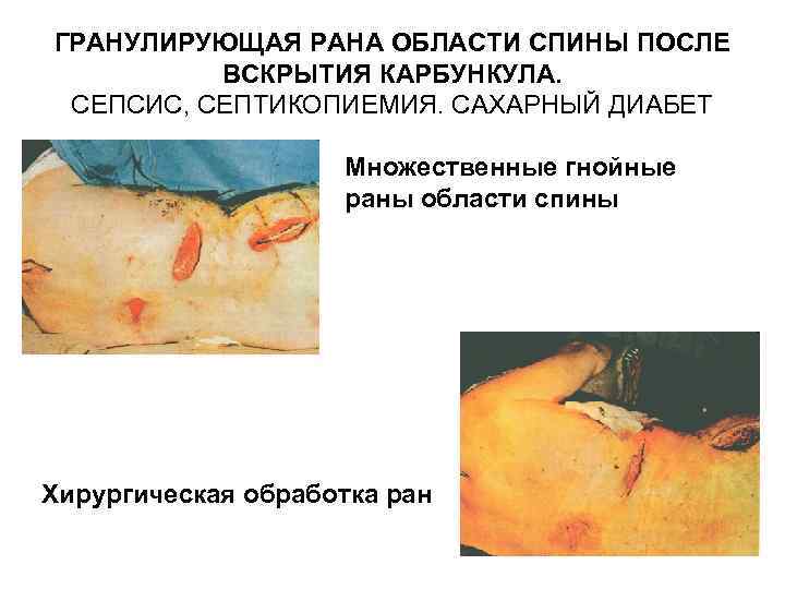 ГРАНУЛИРУЮЩАЯ РАНА ОБЛАСТИ СПИНЫ ПОСЛЕ ВСКРЫТИЯ КАРБУНКУЛА. СЕПСИС, СЕПТИКОПИЕМИЯ. САХАРНЫЙ ДИАБЕТ Множественные гнойные раны