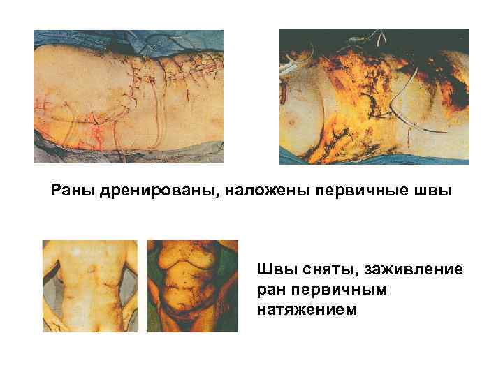 Раны дренированы, наложены первичные швы Швы сняты, заживление ран первичным натяжением 