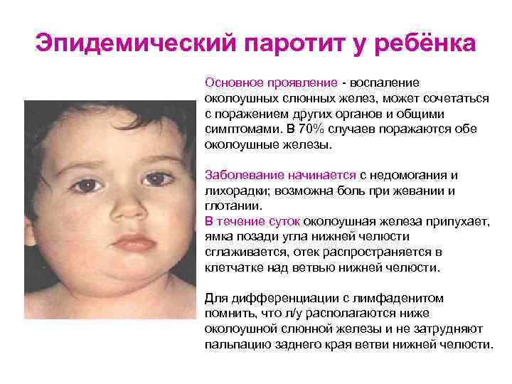Эпидемический паротит у ребёнка Основное проявление - воспаление околоушных слюнных желез, может сочетаться с