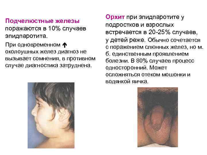 Подчелюстные железы поражаются в 10% случаев эпидпаротита. При одновременном околоушных желез диагноз не вызывает