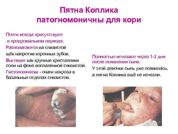 Пятна Коплика патогномоничны для кори Почти всегда присутствуют в продромальном периоде. Располагаются на слизистой