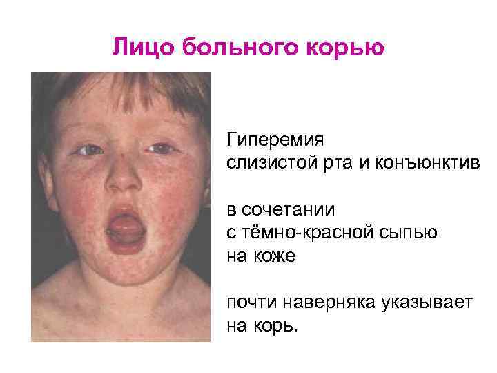 Лицо больного корью Гиперемия слизистой рта и конъюнктив в сочетании с тёмно-красной сыпью на
