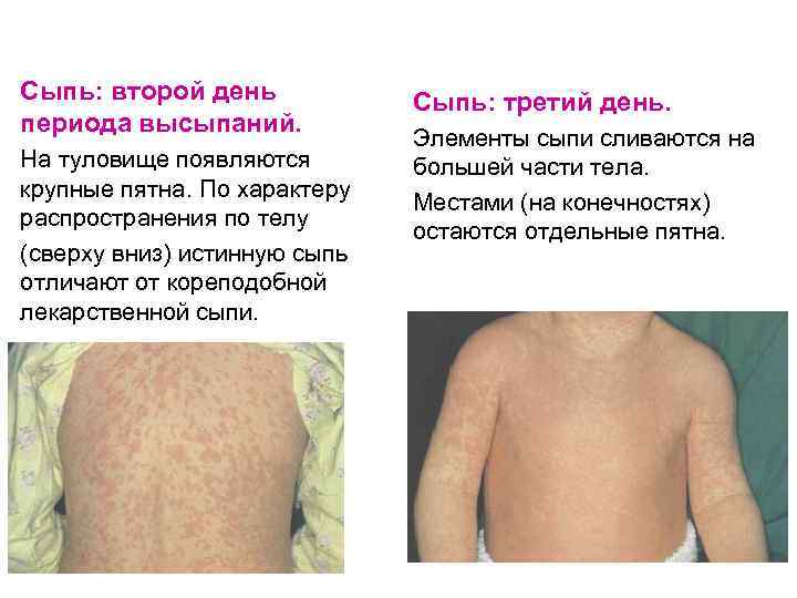 Сыпь: второй день периода высыпаний. На туловище появляются крупные пятна. По характеру распространения по