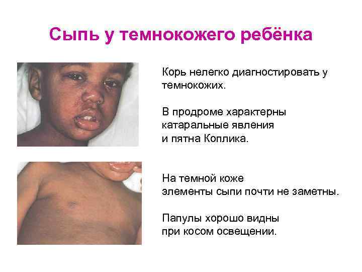 Сыпь у темнокожего ребёнка Корь нелегко диагностировать у темнокожих. В продроме характерны катаральные явления