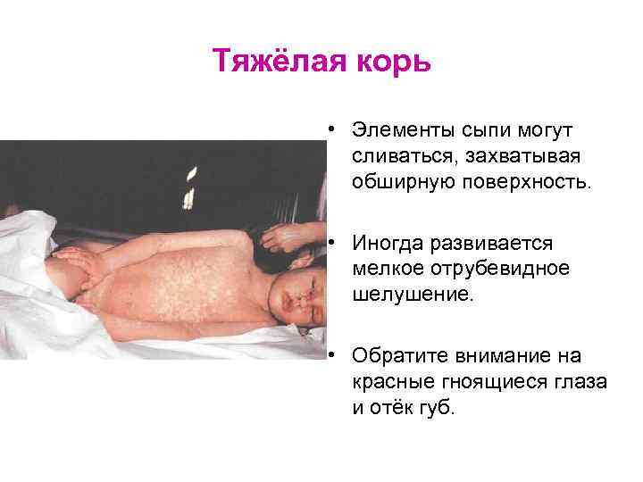 Тяжёлая корь • Элементы сыпи могут сливаться, захватывая обширную поверхность. • Иногда развивается мелкое