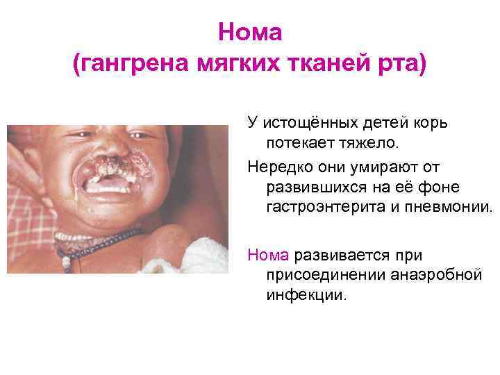 Нома (гангрена мягких тканей рта) У истощённых детей корь потекает тяжело. Нередко они умирают