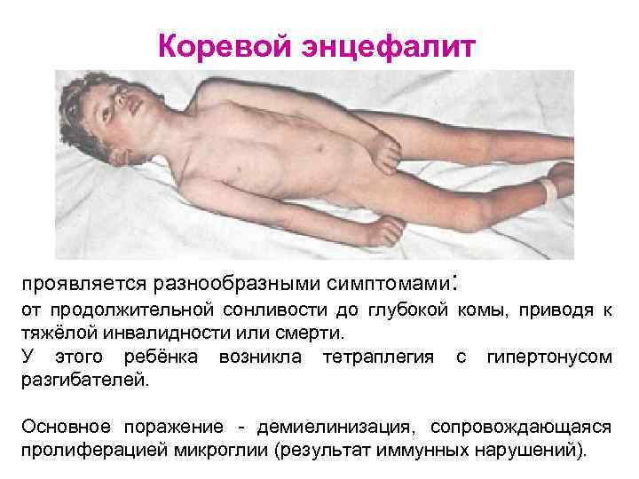 Коревой энцефалит проявляется разнообразными симптомами: от продолжительной сонливости до глубокой комы, приводя к тяжёлой