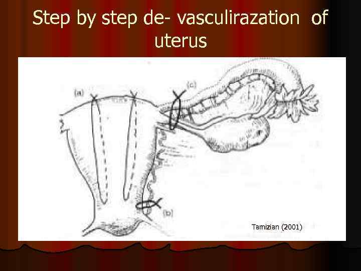 Step by step de- vasculirazation of uterus Tamizian (2001) 