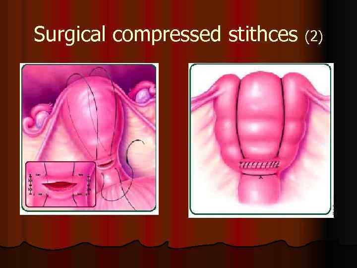 Surgical compressed stithces (2) 