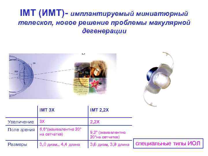 IMT (ИМТ)- имплантируемый миниатюрный телескоп, новое решение проблемы макулярной дегенерации IMT 3 X IMT
