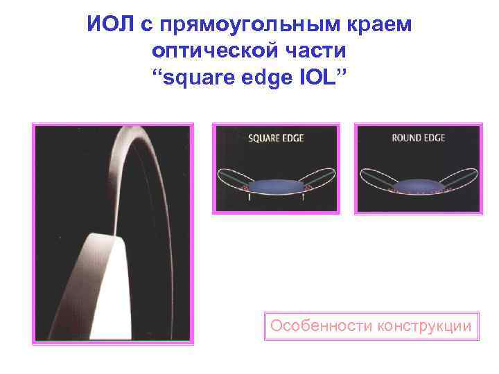 ИОЛ с прямоугольным краем оптической части “square edge IOL” Особенности конструкции 