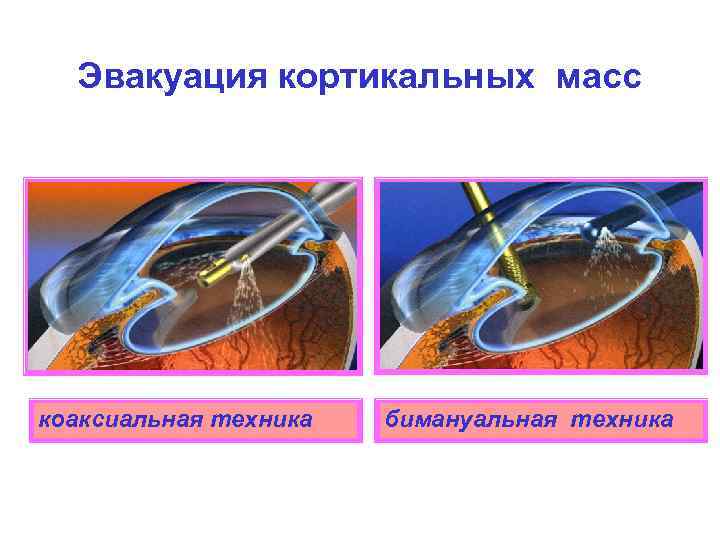 Эвакуация кортикальных масс коаксиальная техника бимануальная техника 