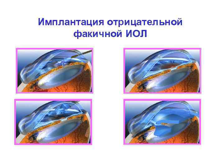 Имплантация отрицательной факичной ИОЛ 