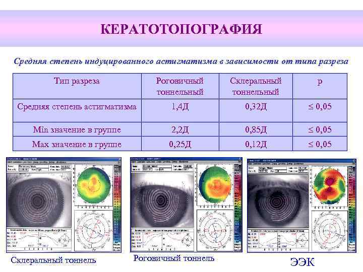 КЕРАТОТОПОГРАФИЯ Средняя степень индуцированного астигматизма в зависимости от типа разреза Тип разреза Роговичный тоннельный