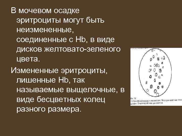 В мочевом осадке эритроциты могут быть неизмененные, соединенные с Hb, в виде дисков желтовато-зеленого