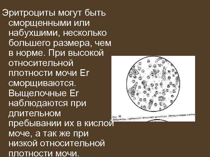 Эритроциты могут быть сморщенными или набухшими, несколько большего размера, чем в норме. При высокой