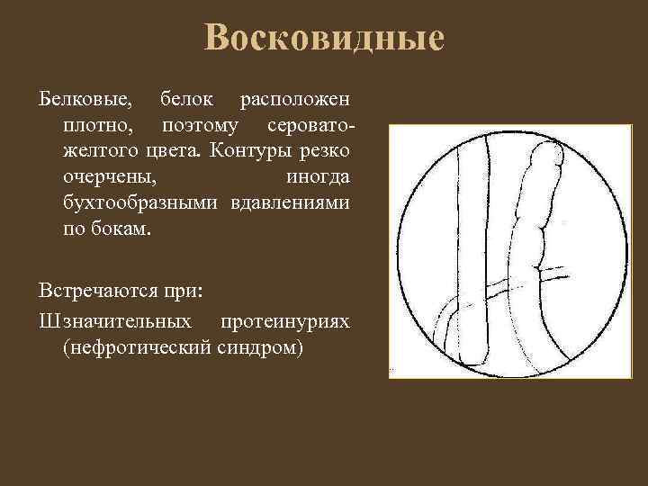 Восковидные Белковые, белок расположен плотно, поэтому сероватожелтого цвета. Контуры резко очерчены, иногда бухтообразными вдавлениями