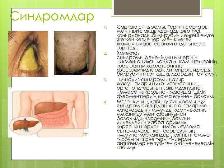 Синдромдар 1. 2. 3. 4. Сарғаю синдромы. Терінің сарғаюы мен нәжіс ақшылданады, эәр түсі
