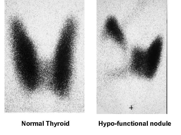 Normal Thyroid Hypo-functional nodule 