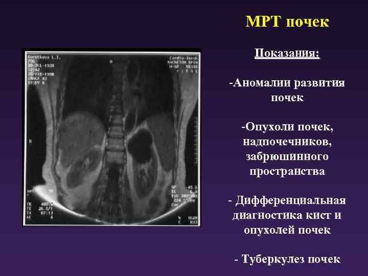 МРТ почек Показания: -Аномалии развития почек -Опухоли почек, надпочечников, забрюшинного пространства - Дифференциальная диагностика